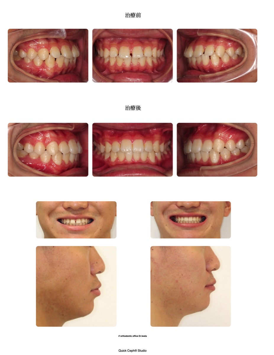 空隙歯列症例　＜正中離開を伴う上下顎空隙歯列に対する非抜歯矯正治療＞