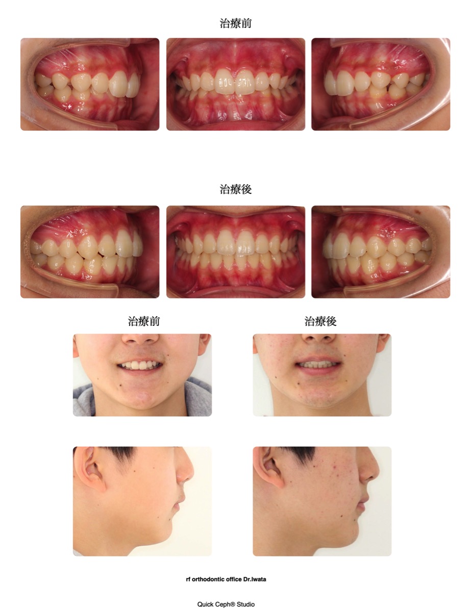 過盖咬合症例　＜下顎後退を併う過蓋咬合に対する非抜歯矯正治療＞