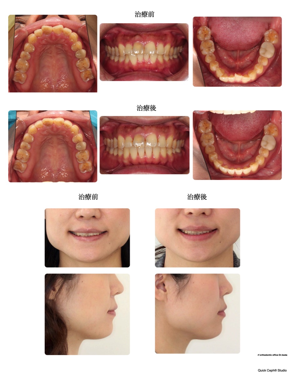叢生症例　＜矯正の後戻りにより生じた前歯叢生に対する非抜歯矯正治療＞