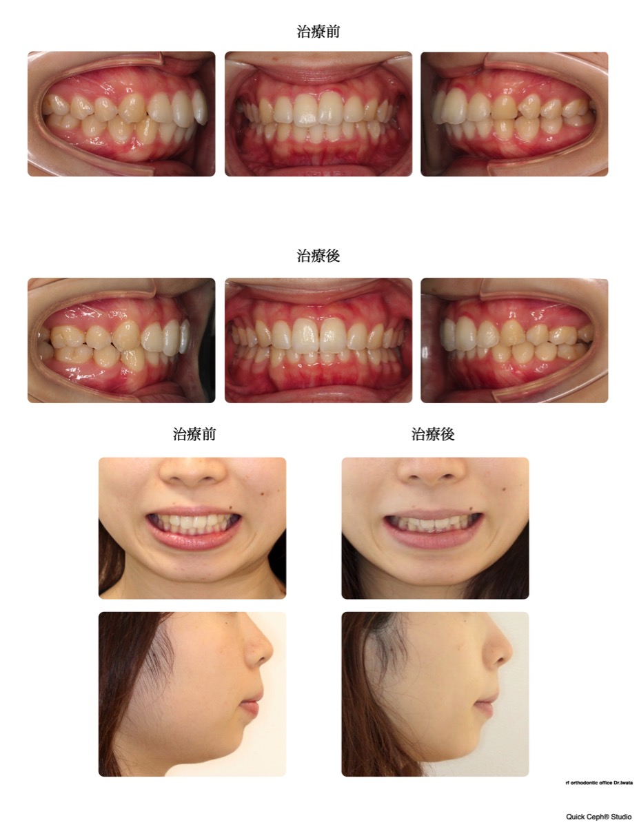 上下顎前突症例 　＜３本抜歯により正中のズレを伴う口元の前突を改善した抜歯矯正治療＞