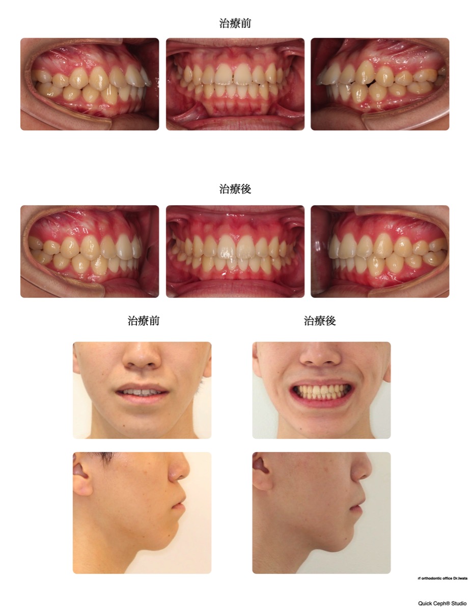 上下顎前突症例 　＜IPR（ディスキング）によりスペースを作り前突を改善した非抜歯矯正治療＞