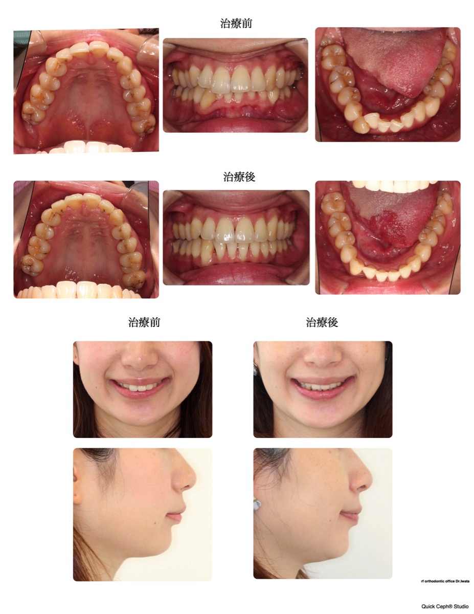 過盖咬合症例　＜先天欠損と重度叢生を併う過蓋咬合に対する非抜歯矯正治療＞