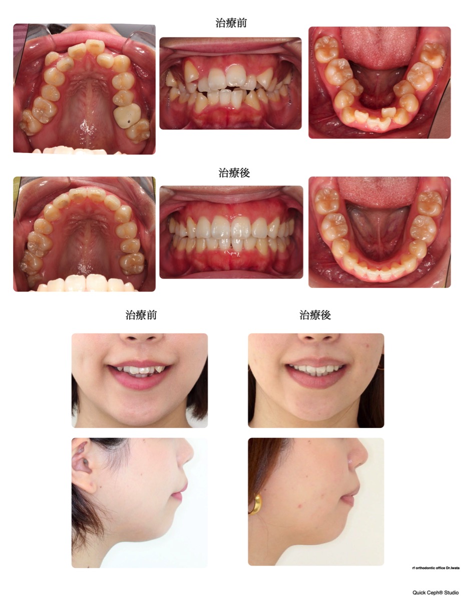 叢生症例　＜保存不可の大臼歯抜歯スペースを利用した抜歯矯正治療＞
