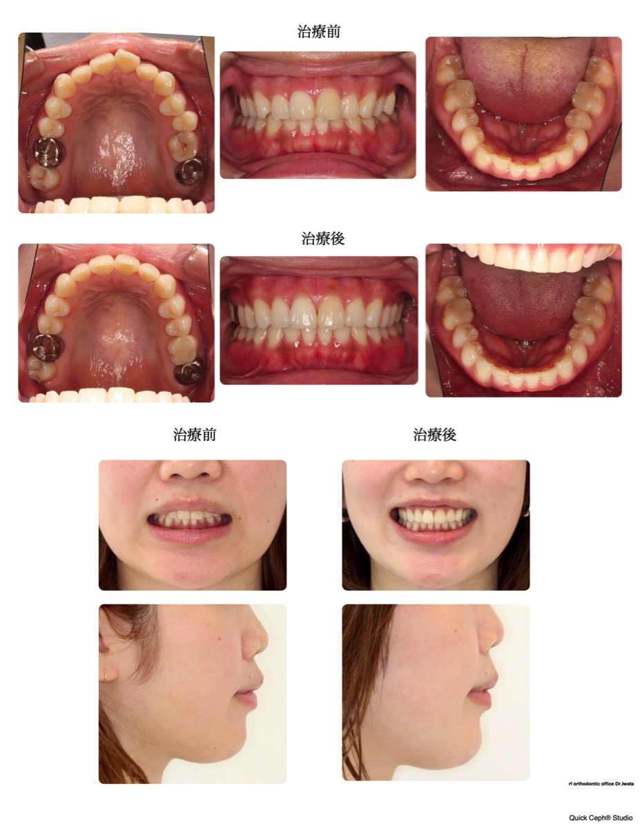 叢生症例　＜過蓋咬合を伴う叢生に対する非抜歯矯正治療＞