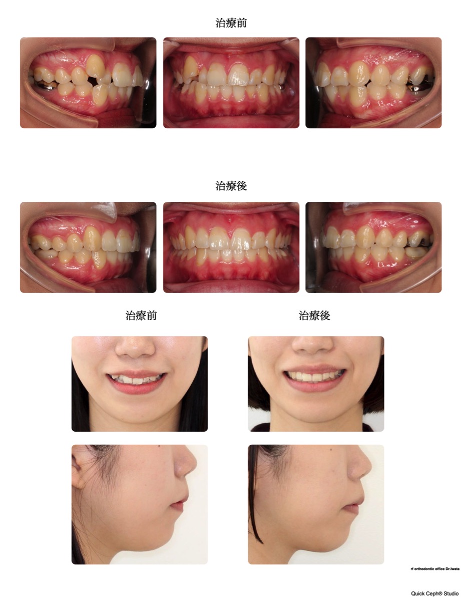 叢生症例　＜右側の八重歯を伴う叢生に対して上顎遠心移動を行なった非抜歯矯正治療＞