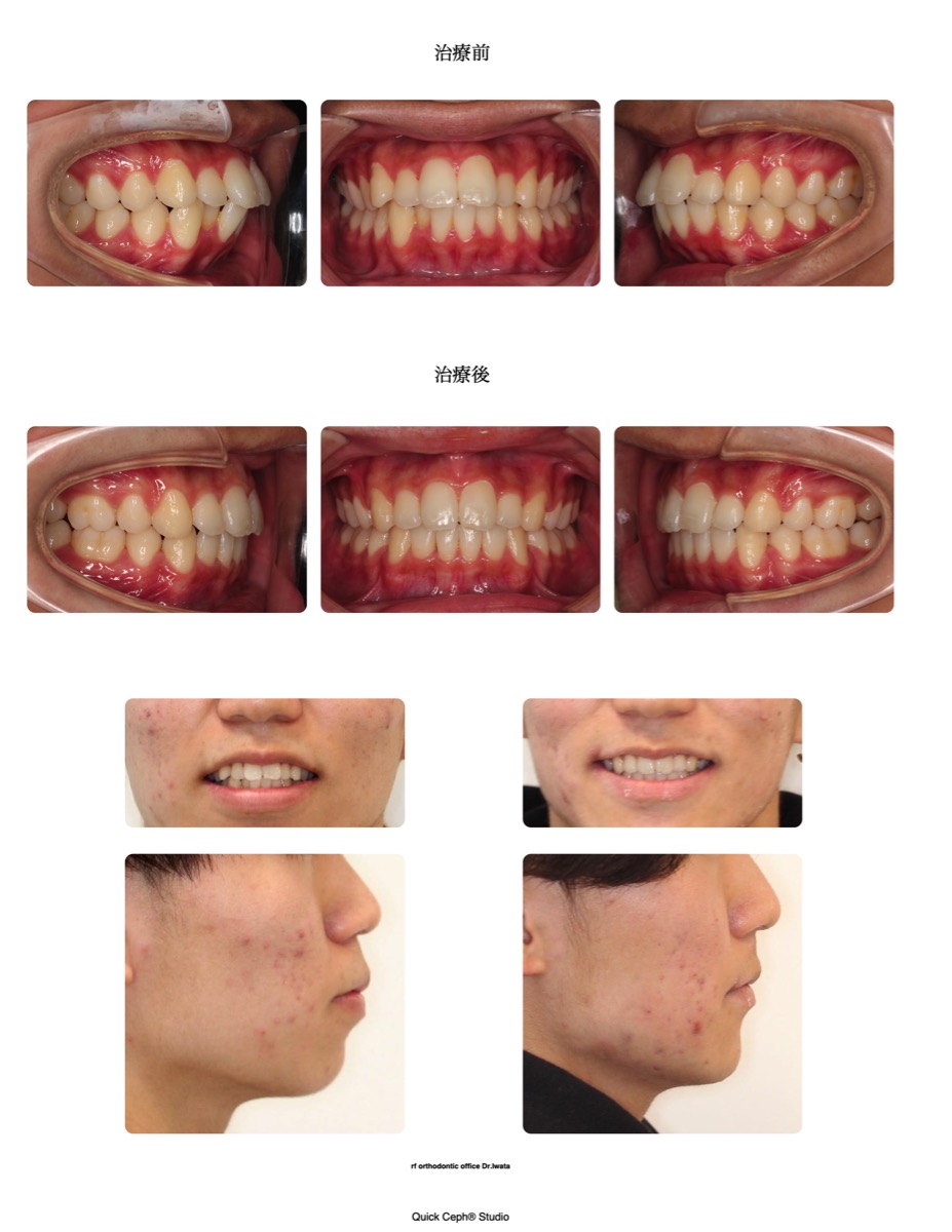 上下顎前突症例 　＜上下顎小臼歯抜歯により叢生と口元の前突を改善した抜歯矯正治療＞