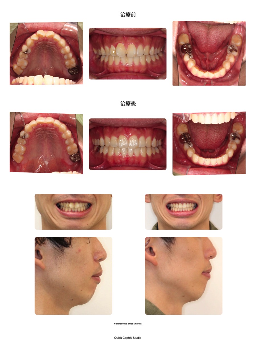 叢生症例　＜翼状捻転を伴う叢生に対する非抜歯矯正治療＞