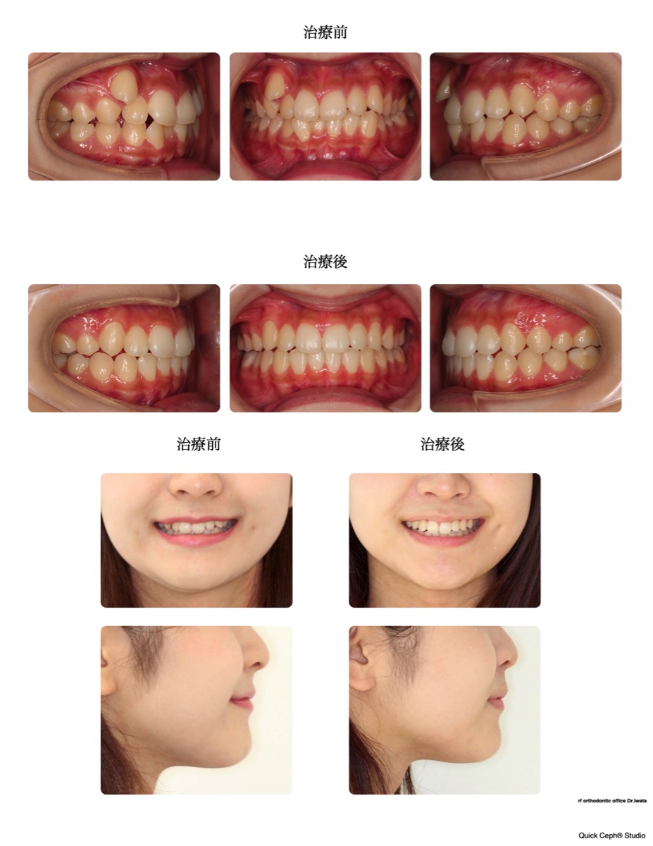叢生症例 <片側の八重歯を1本抜歯にて改善した抜歯矯正治療>