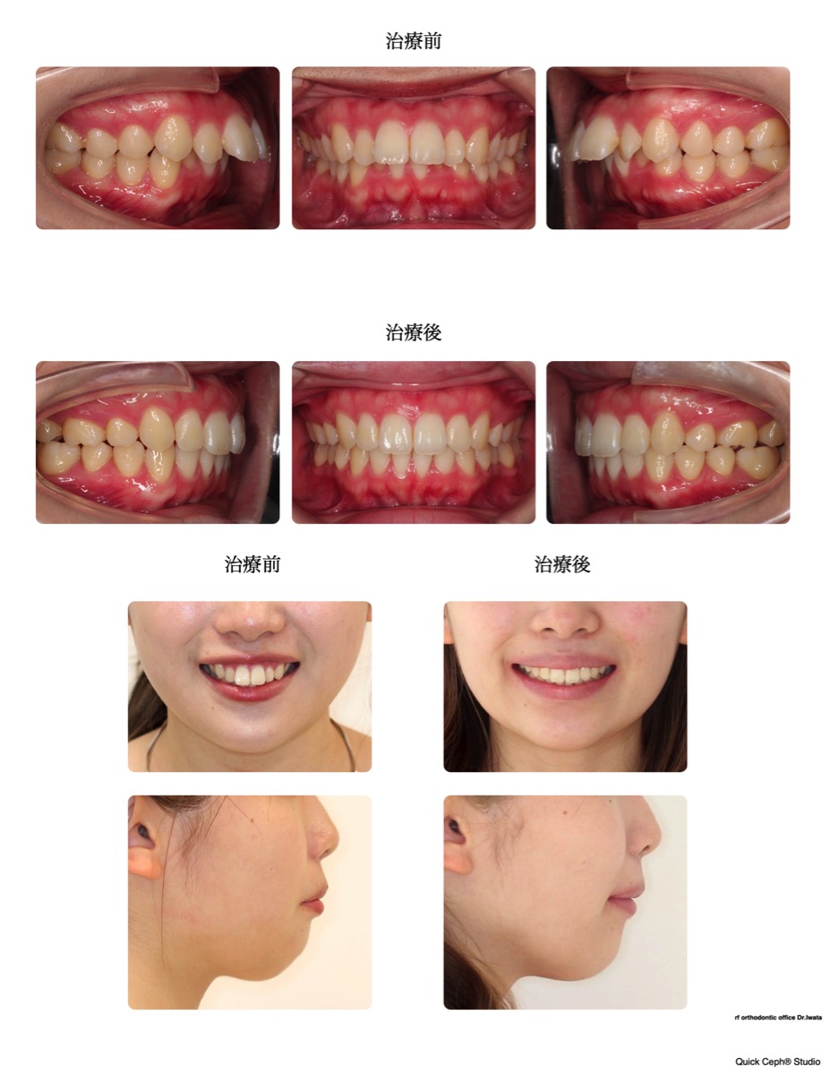 上顎前突症例 <上顎2本抜歯にて口元の前突を改善した抜歯矯正治療>