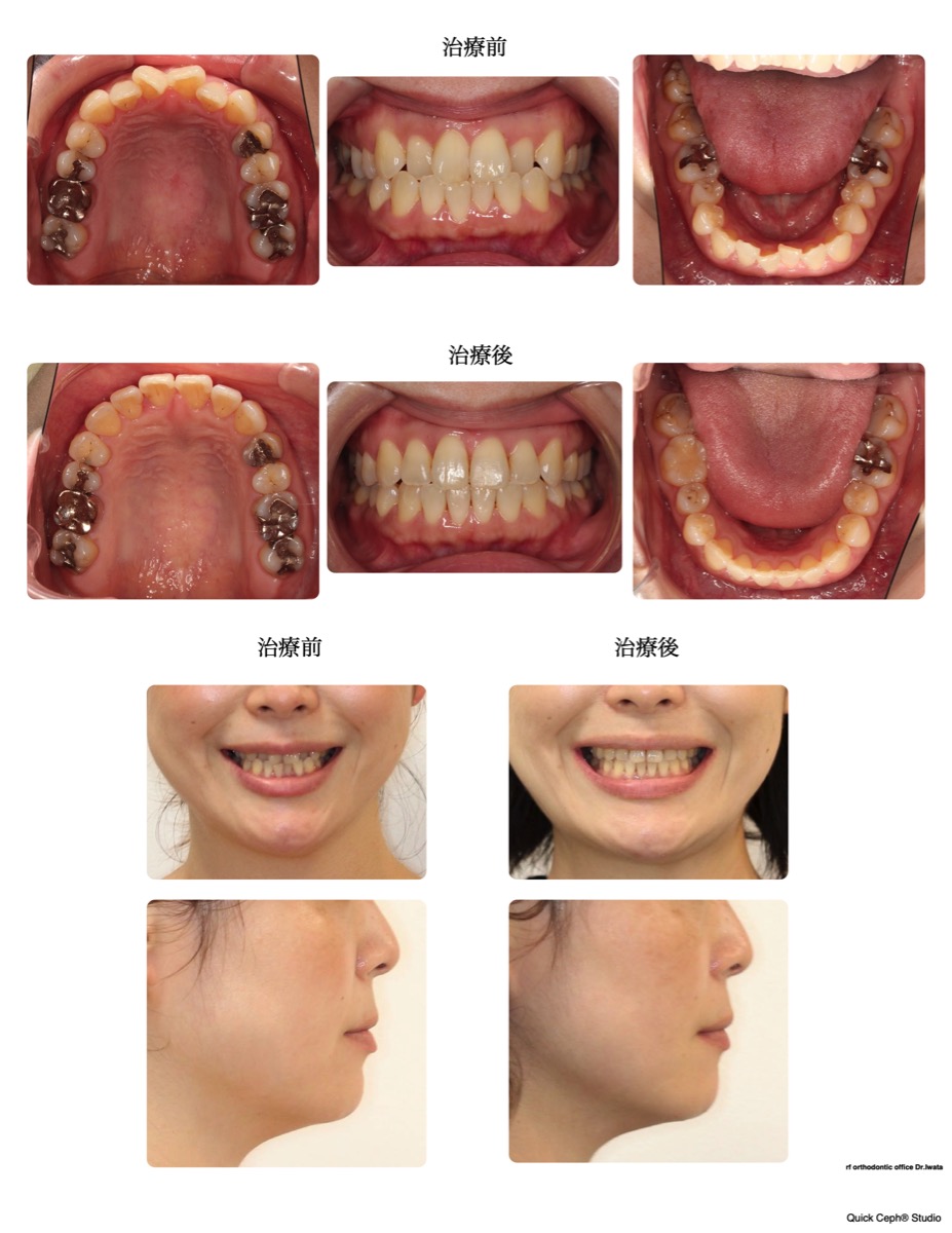 下顎前突症例 <叢生を伴う反対咬合に対する非抜歯矯正治療>
