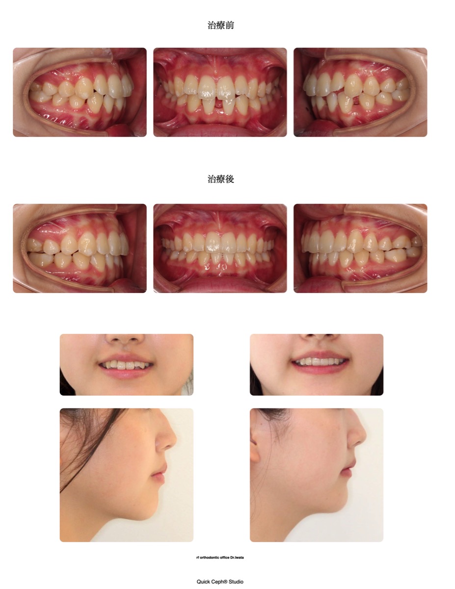 空隙歯列症例　＜下顎前歯先天欠損による空隙歯列に対する非抜歯矯正治療＞