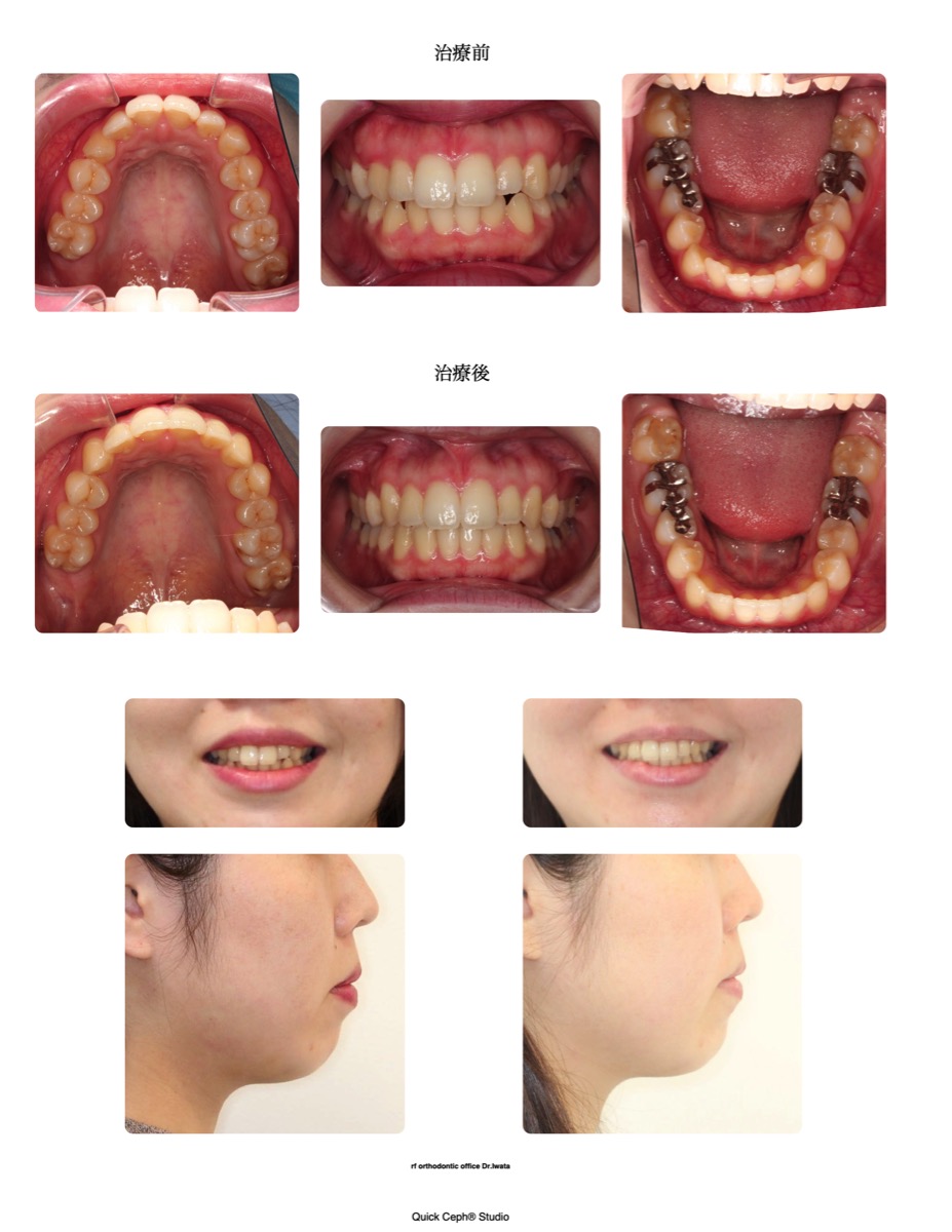 叢生症例 <上下顎前歯の叢生に対する非抜歯矯正治療>