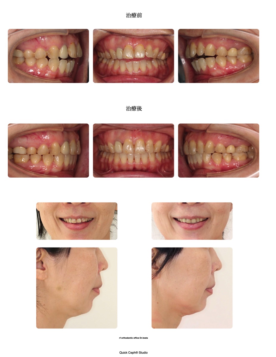 開咬症例 <下顎後退を伴う開咬に対する非抜歯矯正治療>