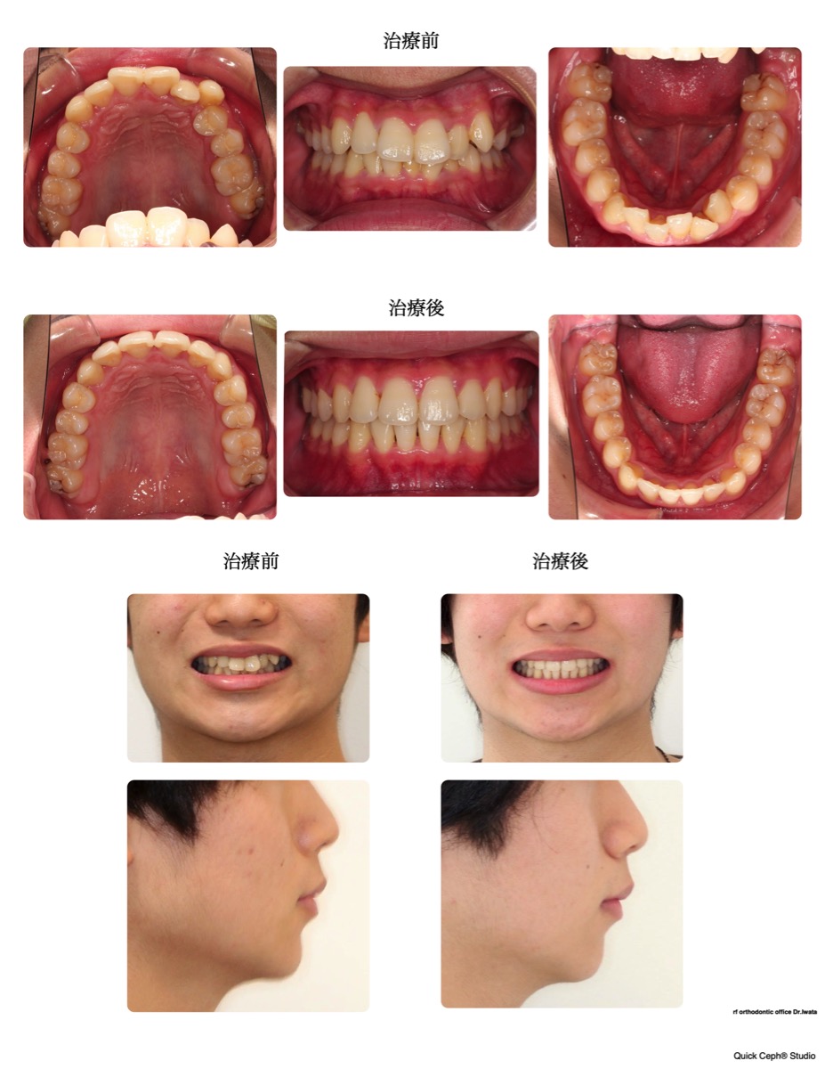 鋏状咬合症例 　＜叢生と過蓋咬合を伴う両側鋏状咬合（シザースバイト）に対する非抜歯矯正治療＞