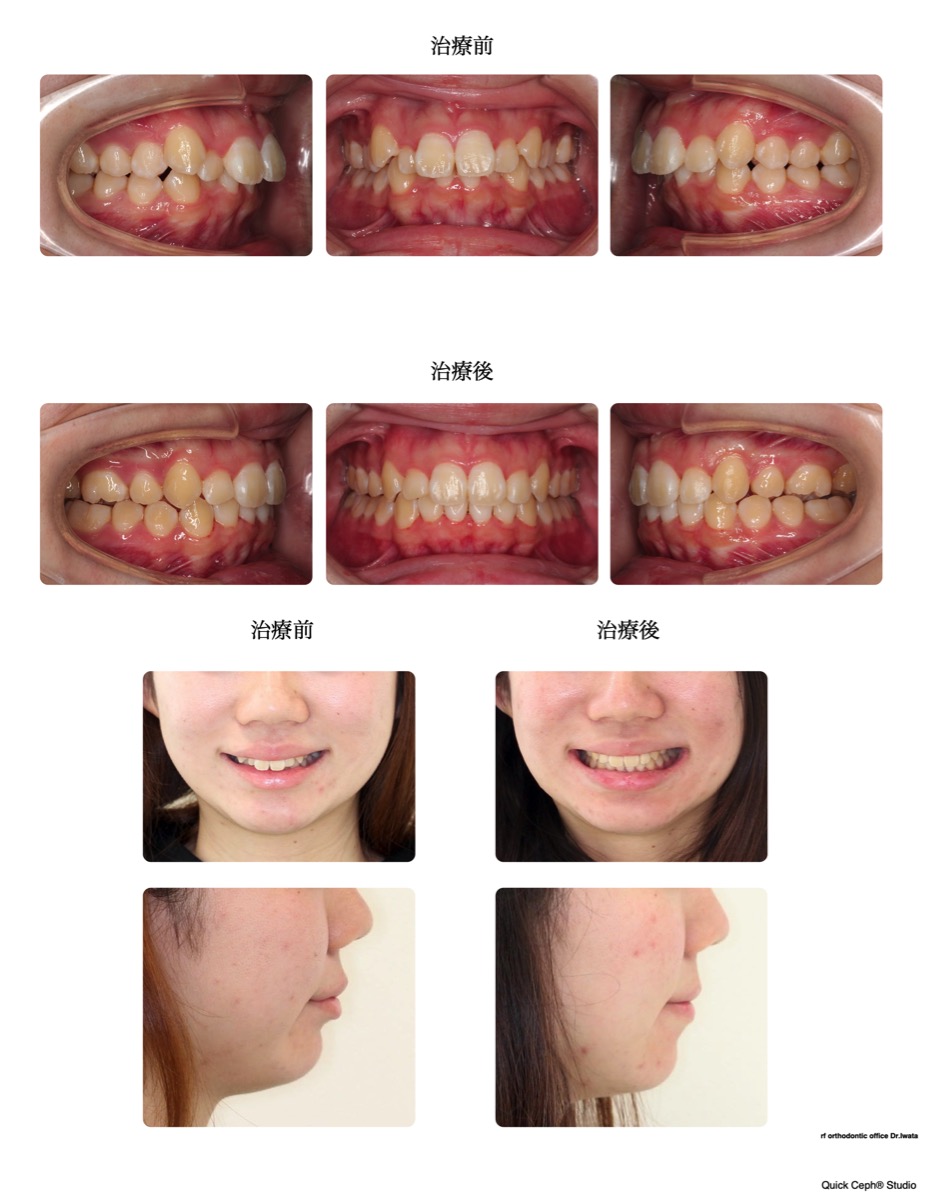 上顎前突症例 　＜上顎２本抜歯にて叢生と前突を改善した抜歯矯正治療＞
