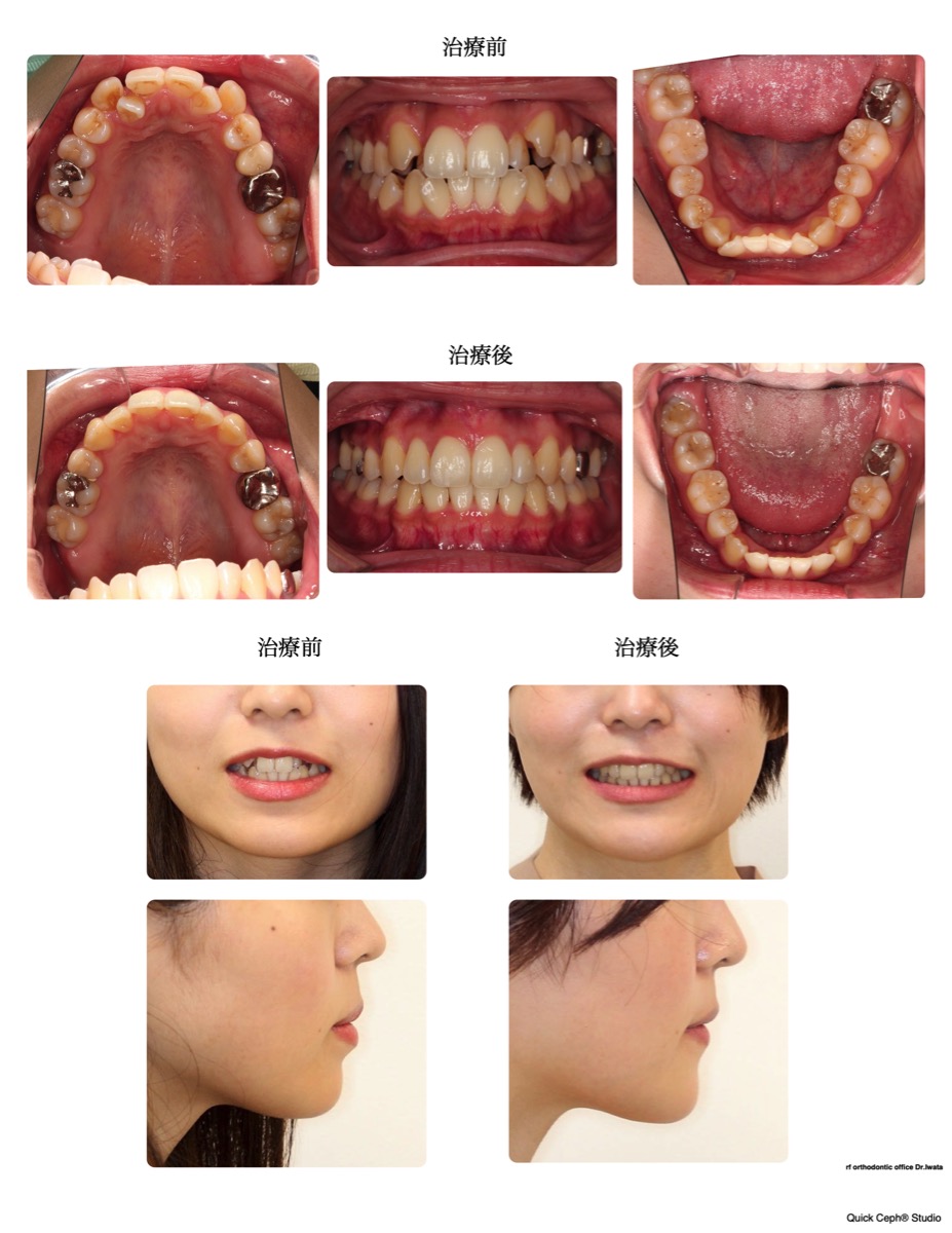 叢生症例　＜正中のズレを伴う重度叢生に対する左右非対称抜歯矯正治療＞