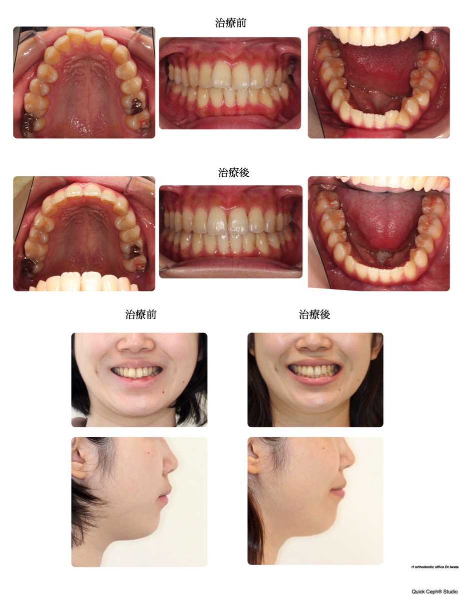交叉咬合症例　＜叢生と正中のズレを伴う交叉咬合に対する非抜歯矯正治療＞