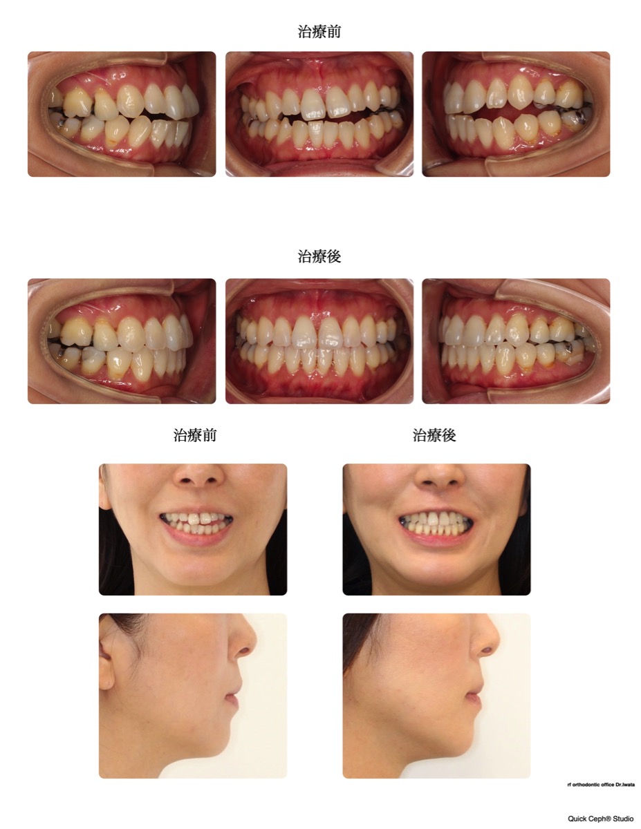 開咬症例 <前歯及び左側方部開咬に対する非抜歯矯正治療>