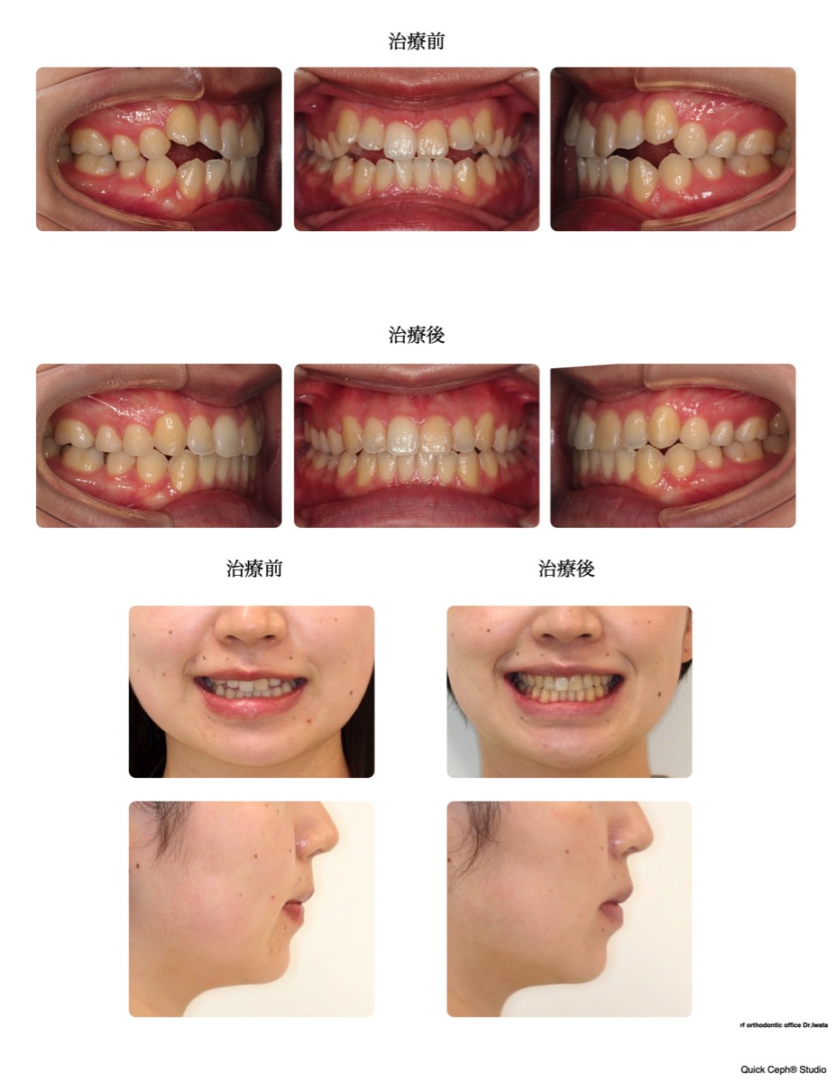 開咬症例 <前歯開咬に対する非抜歯矯正治療>