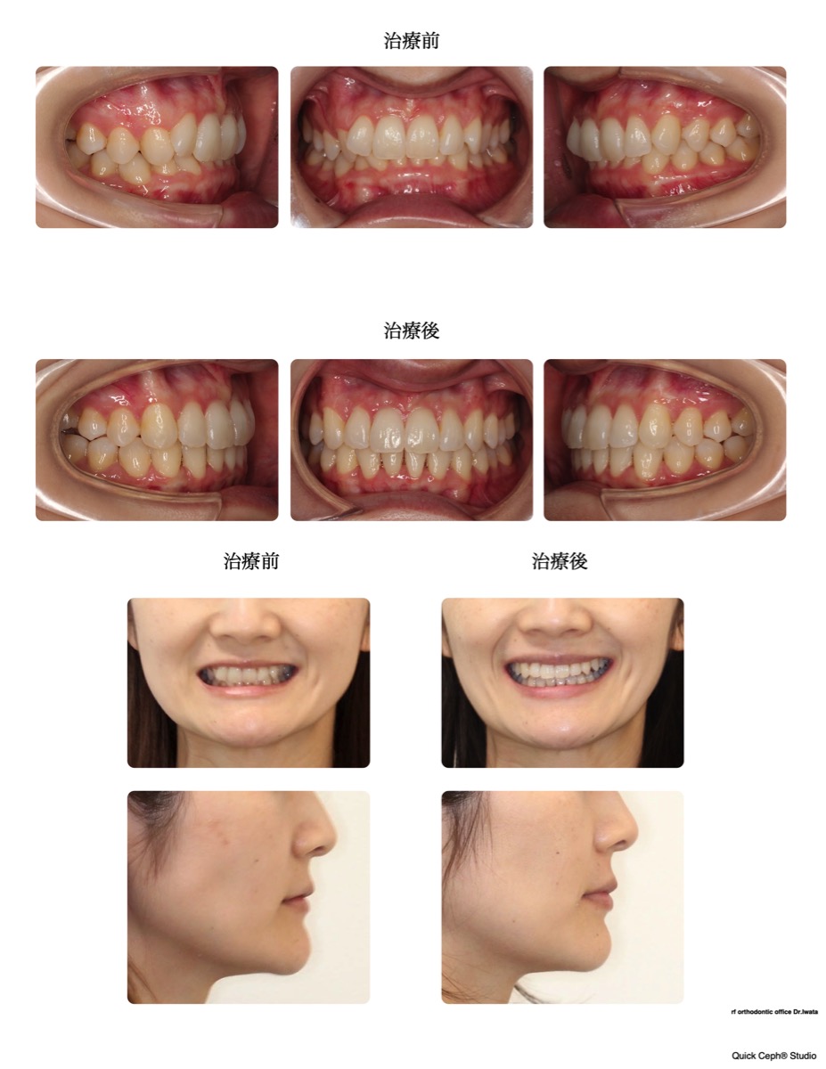 過盖咬合症例　＜叢生を併う過蓋咬合に対する非抜歯矯正治療＞