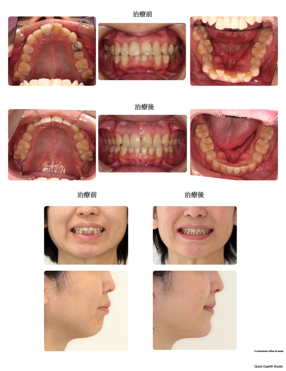 上下顎前突症例 　＜上下顎小臼歯抜歯により叢生と口元の前突を改善した抜歯矯正治療＞