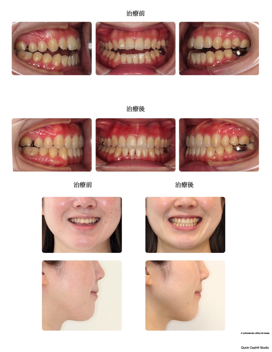 開咬症例 <叢生を伴う開咬に対する非抜歯矯正治療>