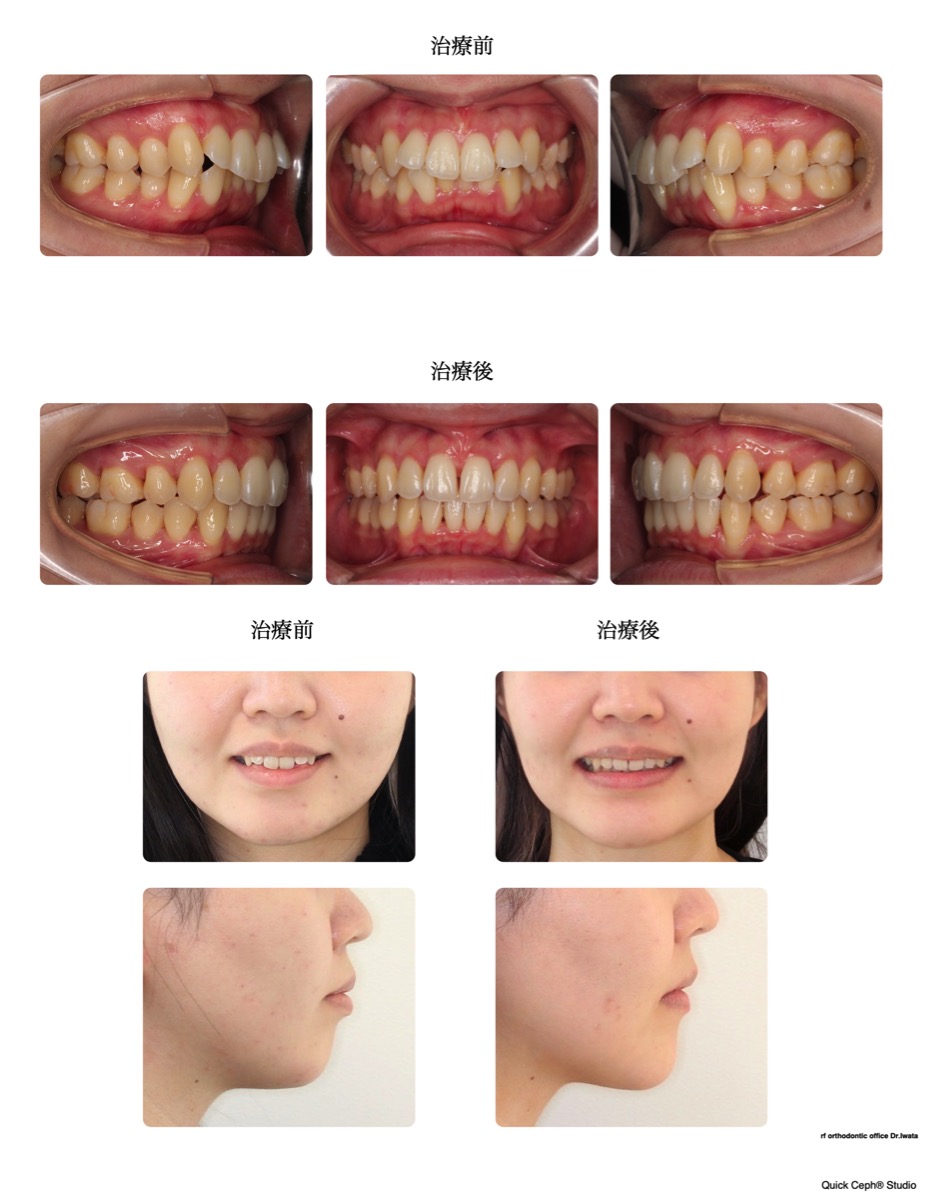 過盖咬合症例　＜叢生と前突を併う過蓋咬合に対する抜歯矯正治療＞