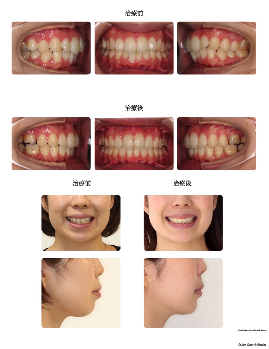 上下顎前突症例 　＜上下顎前歯と口元の前突を改善した抜歯矯正治療＞