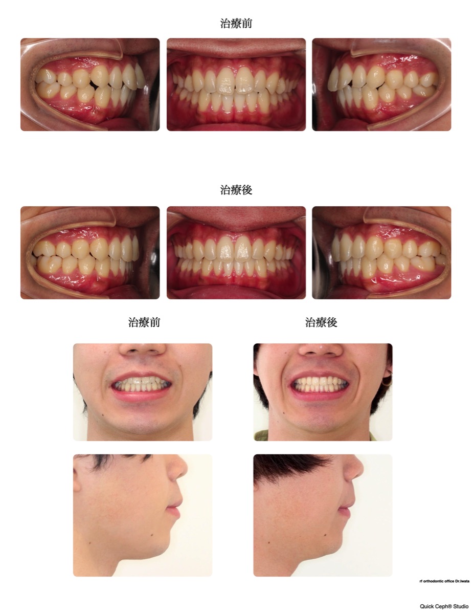 上下顎前突症例 　＜上下顎前歯と口元の前突を改善した非抜歯矯正治療＞