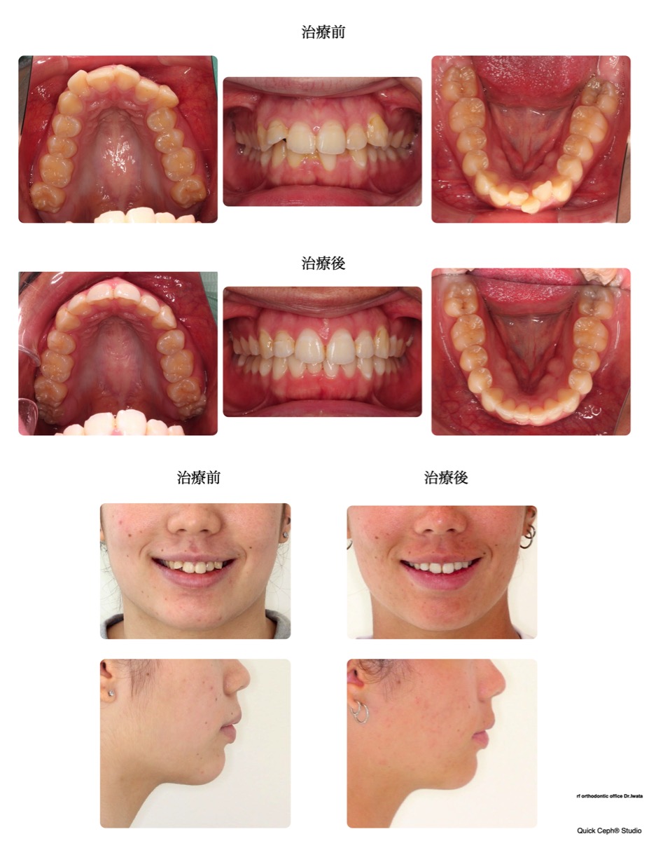 過盖咬合症例　＜叢生を併う過蓋咬合に対する抜歯矯正治療＞