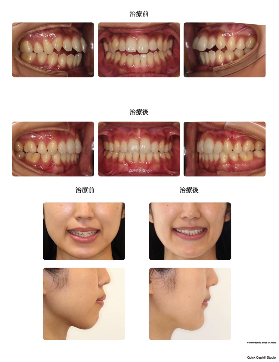 開咬症例 <上下顎前突を伴う開咬に対する抜歯矯正治療>