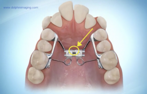 急速拡大装置のネジの回し方は？