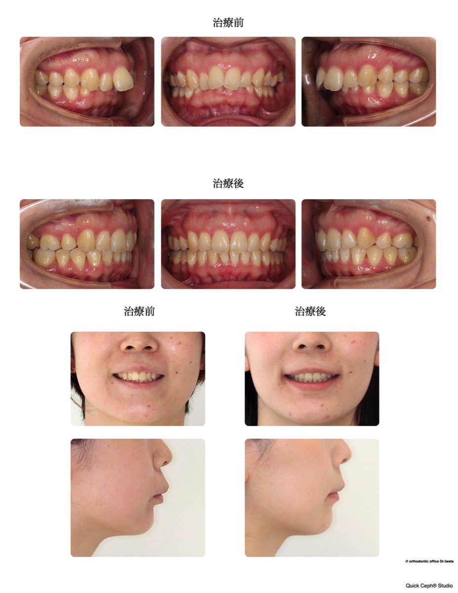 過盖咬合症例　＜上顎前突を併う過蓋咬合に対する抜歯矯正治療＞