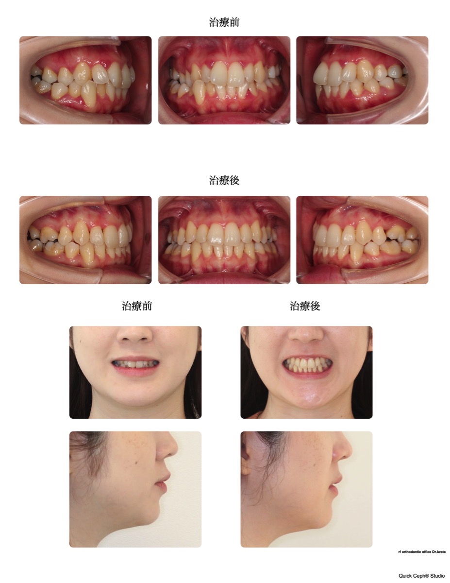 交叉咬合症例　＜叢生を伴う片側交叉咬合に対する抜歯矯正治療＞