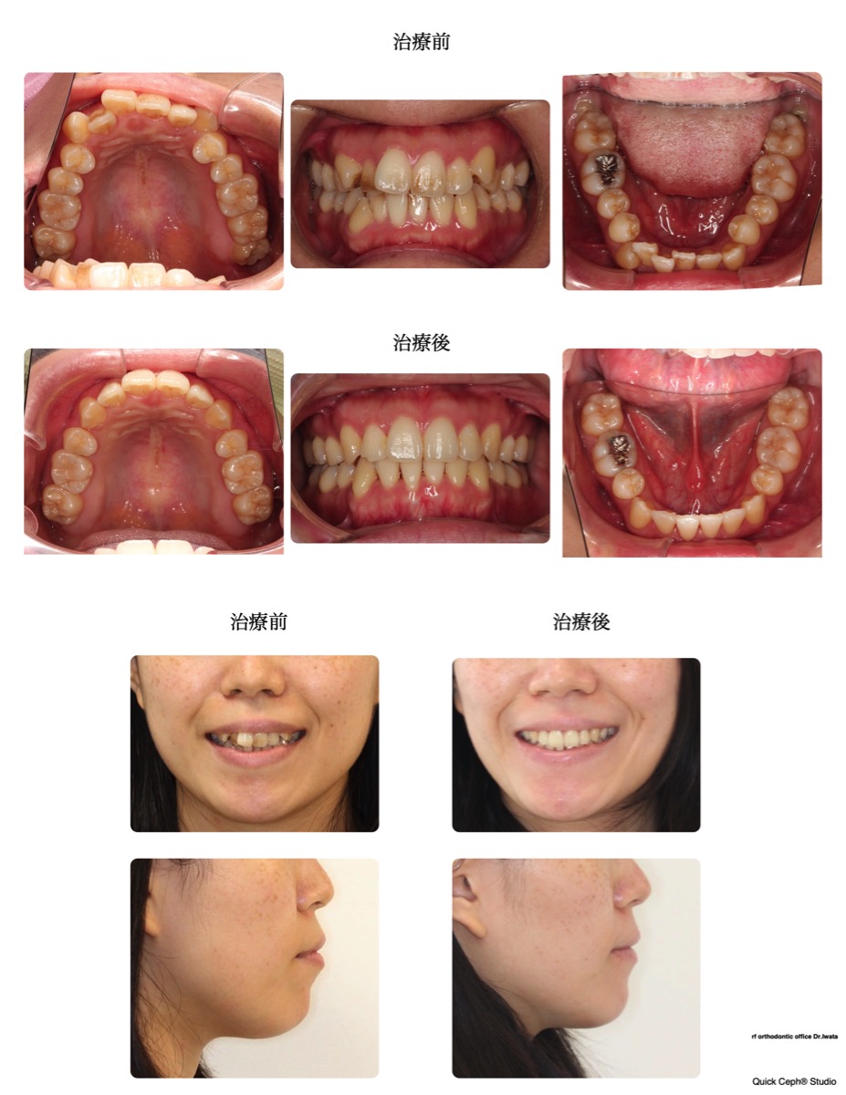 叢生症例　＜前突を伴う重度叢生に対する抜歯矯正治療＞