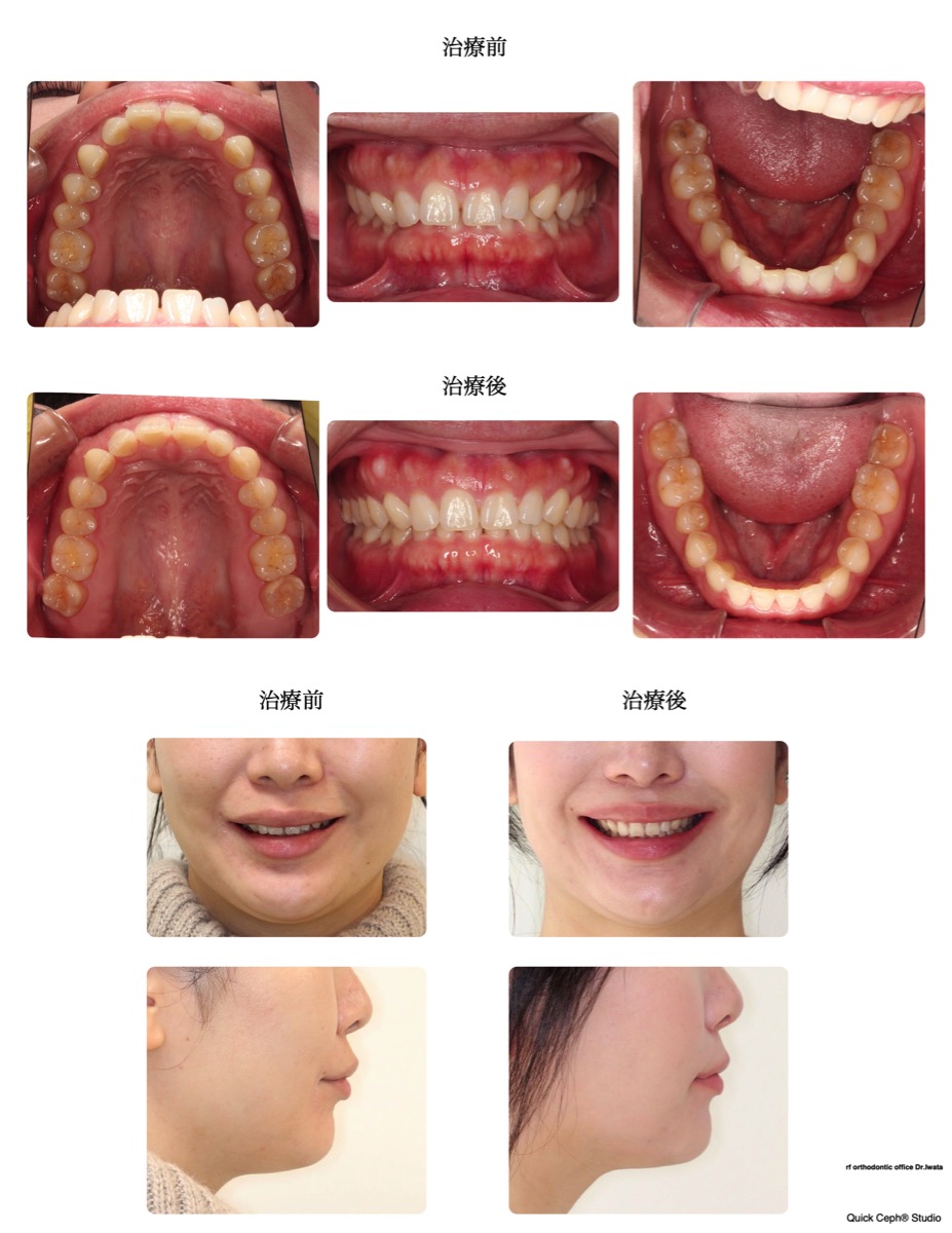 空隙歯列症例　＜過蓋咬合を伴う空隙歯列に対する非抜歯矯正治療＞