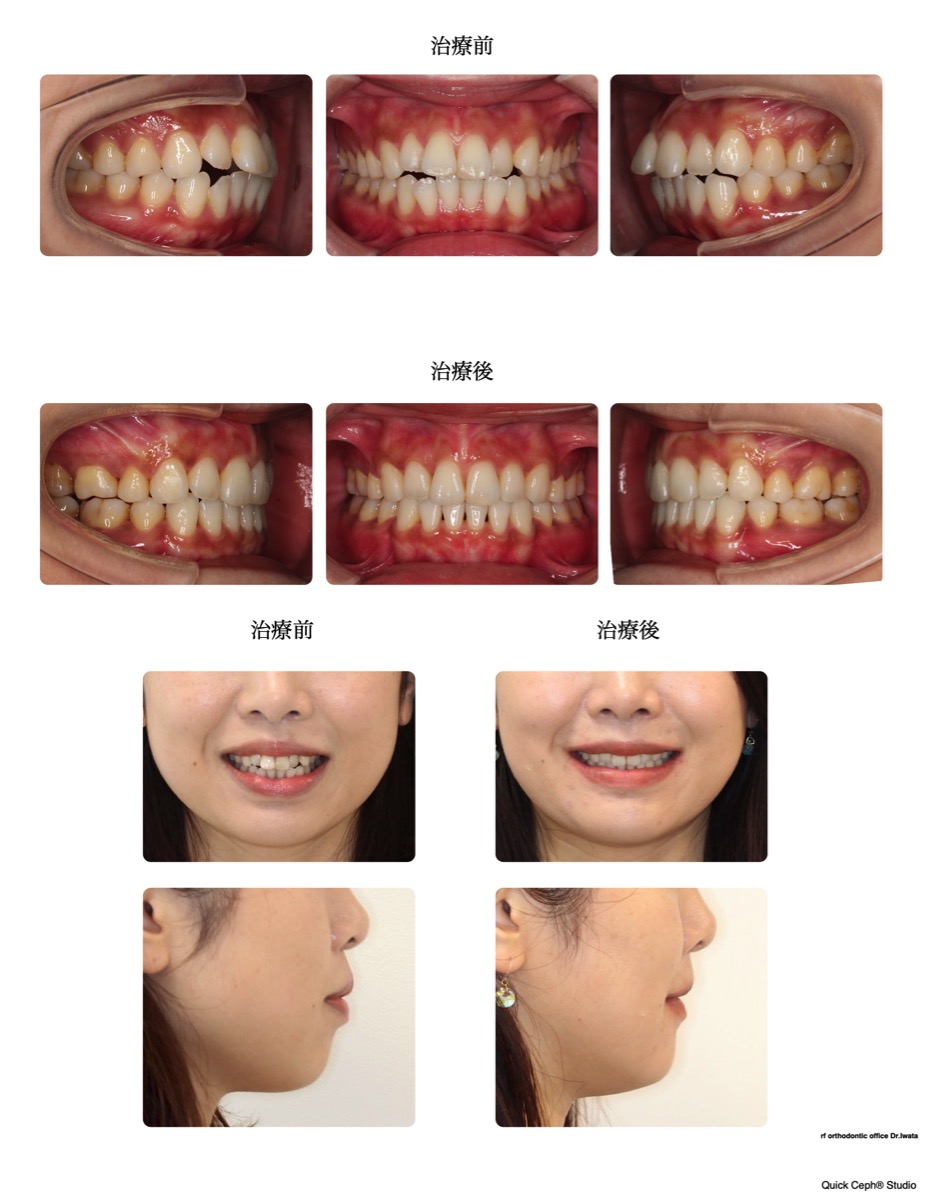 上下顎前突症例 　＜叢生を伴う上下顎前突に対する抜歯矯正治療＞