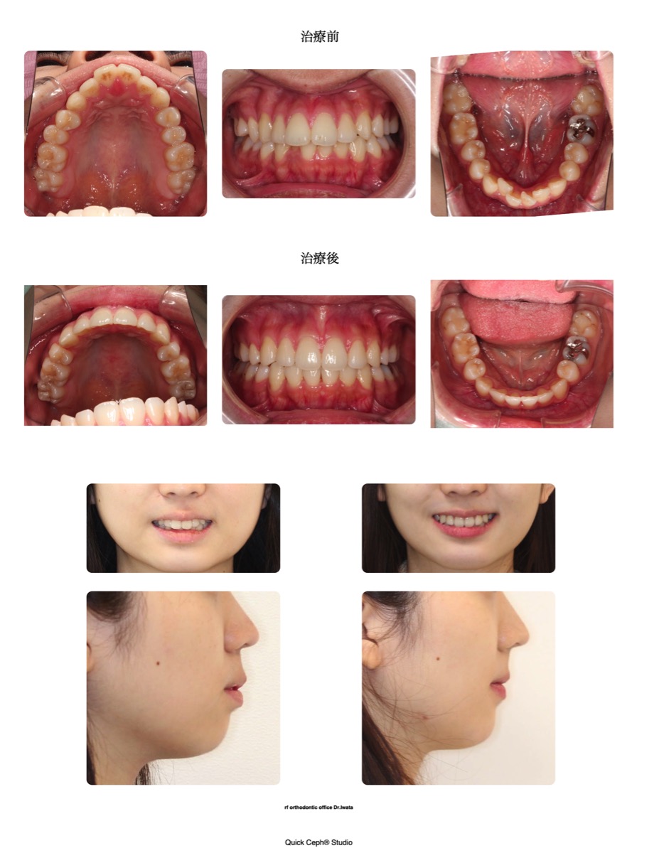 叢生症例　＜前突を伴う下顎叢生に対する抜歯矯正治療＞
