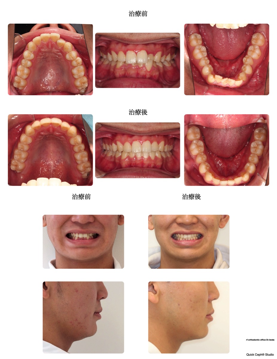 鋏状咬合症例　＜叢生および過蓋咬合を伴う鋏状咬合に対する非抜歯矯正治療＞
