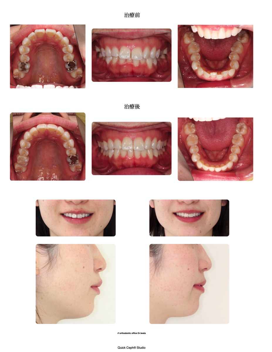 交叉咬合症例　＜上下顎歯列狭窄による交叉咬合に対する非抜歯矯正治療＞