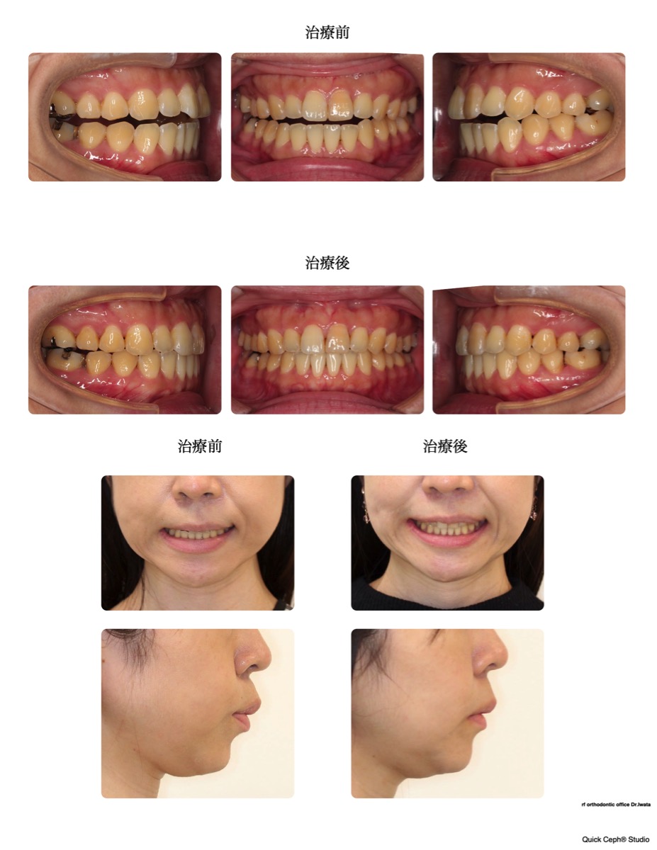 開咬症例 <前歯部および片側開咬に対する非抜歯矯正治療>