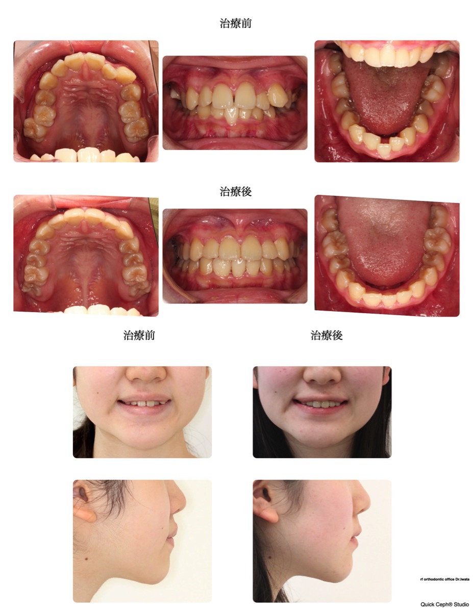 鋏状咬合症例　＜下顎前歯１本先天欠損を伴う叢生および鋏状咬合に対する非抜歯矯正治療＞