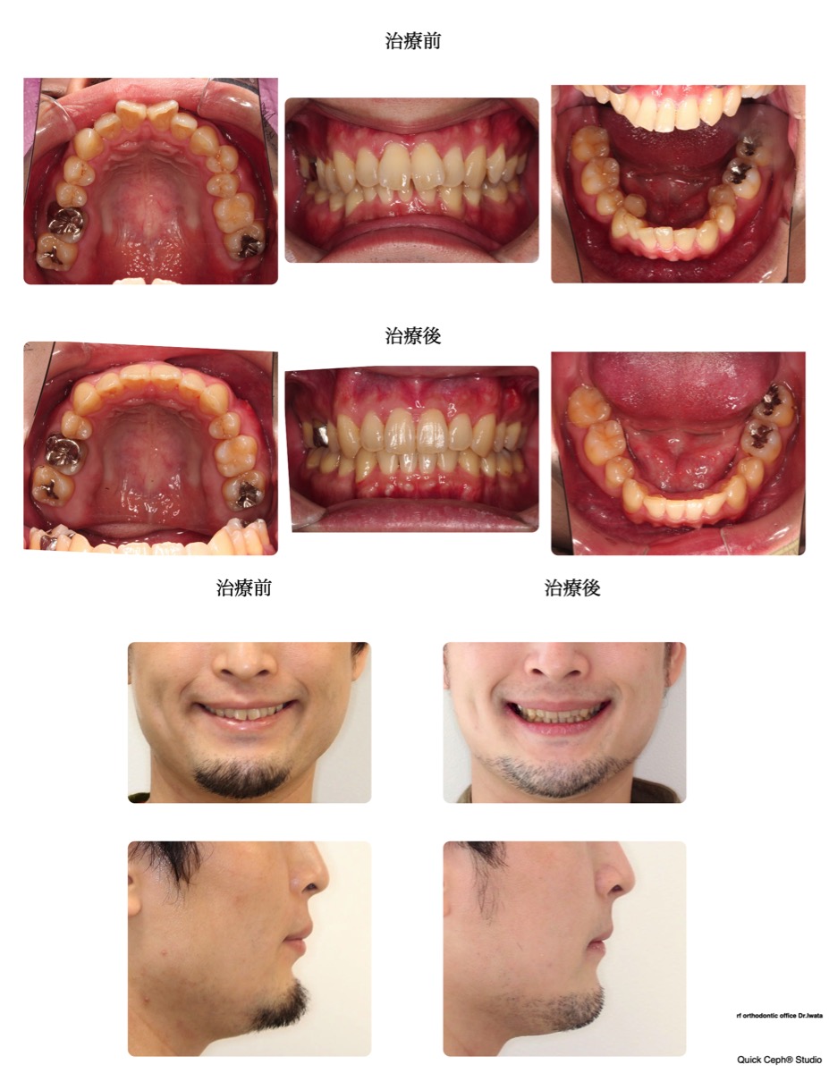 叢生症例　＜過蓋咬合を伴う重度叢生に対する抜歯矯正治療＞
