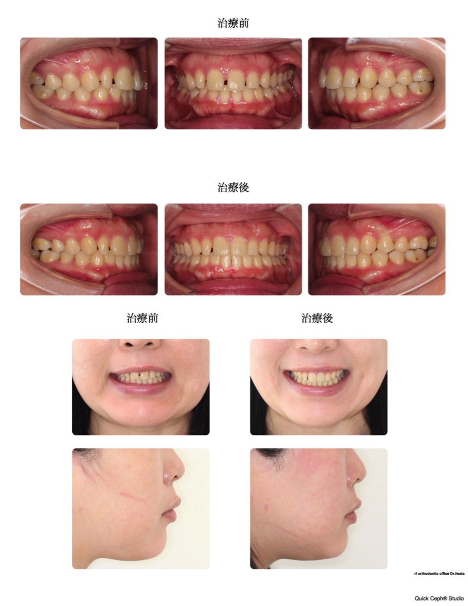 空隙歯列症例　＜過蓋咬合を伴う空隙歯列に対する非抜歯矯正治療＞