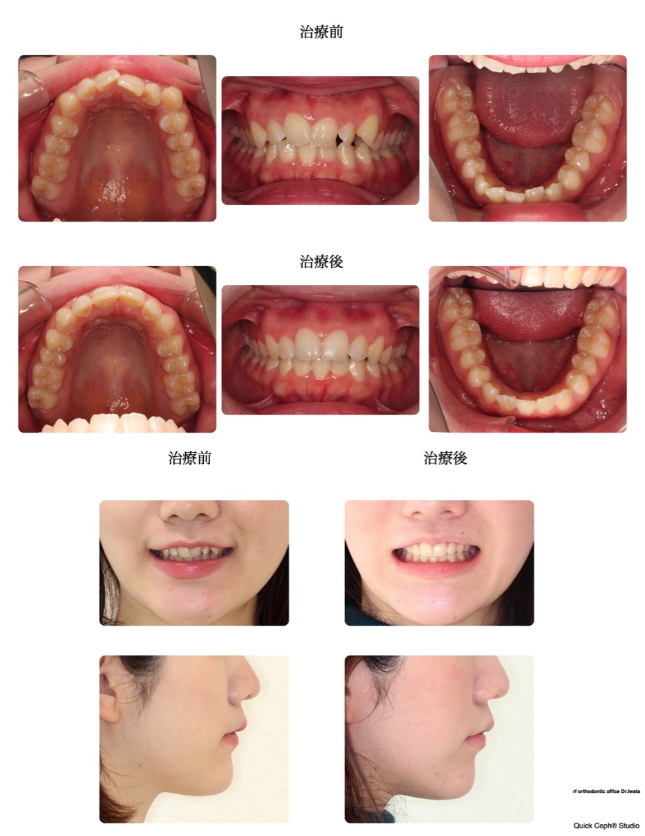 叢生症例　＜下顎前歯先天欠損を伴う叢生に対する非抜歯矯正治療＞