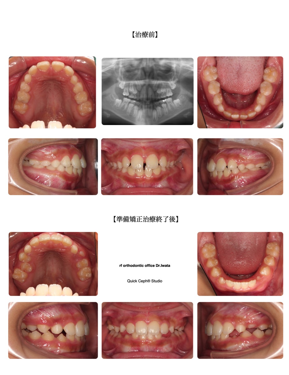 空隙歯列症例　＜上下顎前歯部の空隙歯列に対する準備矯正治療＞