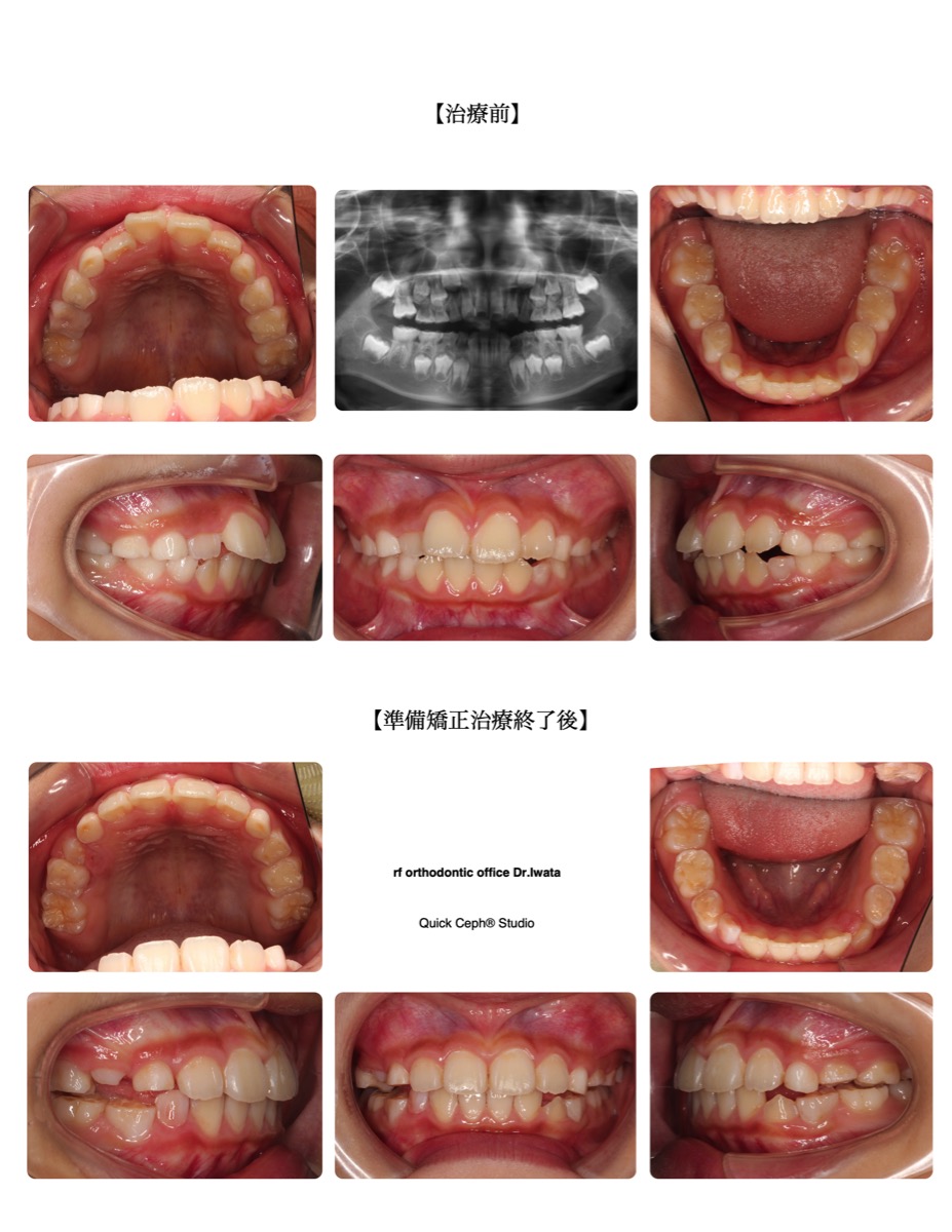 叢生症例　＜舌側転位を伴う叢生に対する準備矯正治療＞