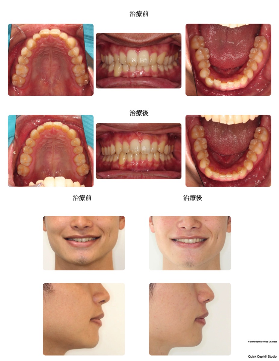 交叉咬合症例　＜叢生を伴う片側交叉咬合に対する非抜歯矯正治療＞