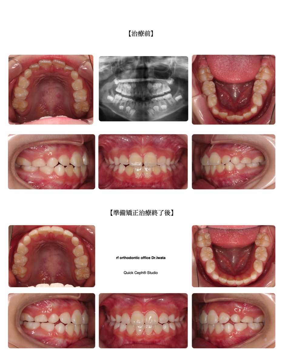 叢生症例　＜上下顎前歯部の叢生に対する準備矯正治療＞