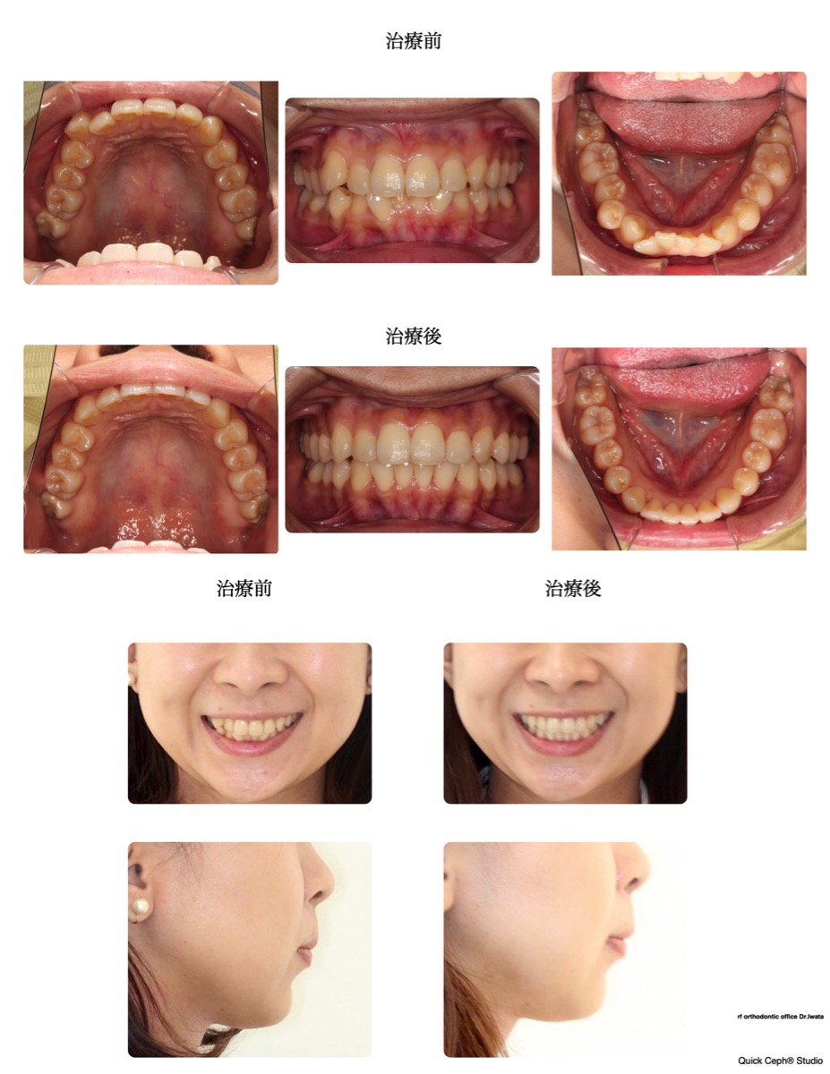 叢生症例　＜重度叢生に対する非抜歯矯正治療＞